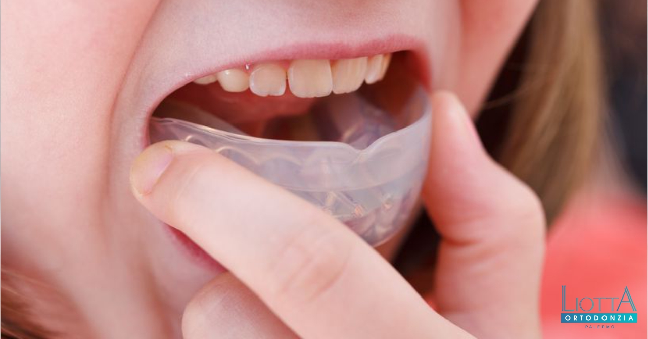 Elastici e apparecchio ortodontico - Studio Dentistico Malara