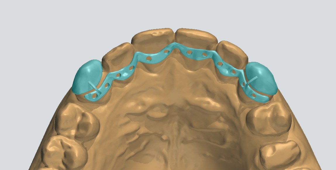 Retainer interamente disegnato